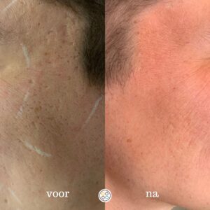 litteken resultaat door laser 