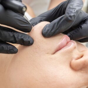 Elektrische epilatie