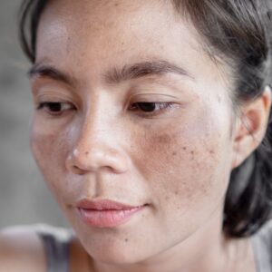 melasma