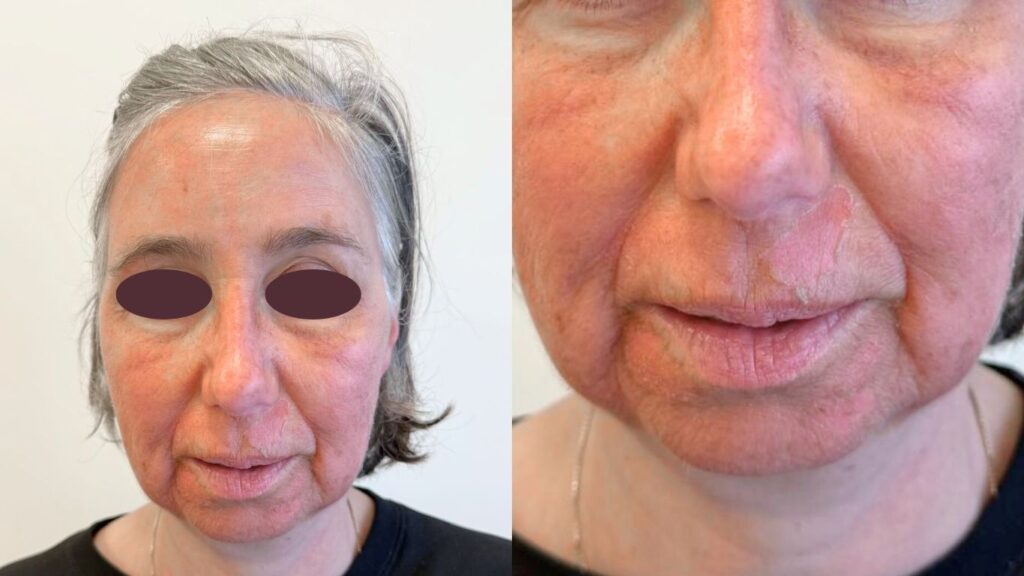 Close-up van een vrouw die is behandeld met de Cosmo Peel Forte, waarbij er zichtbaar velletjes aanwezig zijn en de nieuw huid langzaam tevoorschijn komt. 