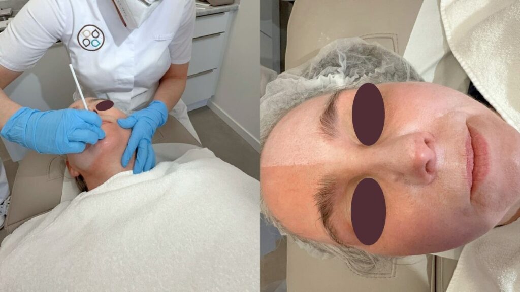 De huidtherapeut brengt de Cosmo Peel Forte aan bij een vrouw die op de behandelbank ligt.