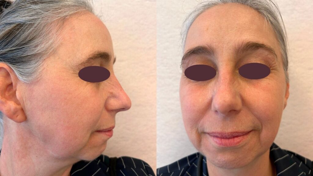 Foto's close-up van de vrouw die de Cosmo Peel Forte heeft ondergaan. De huid ziet er fris en egaal uit. 