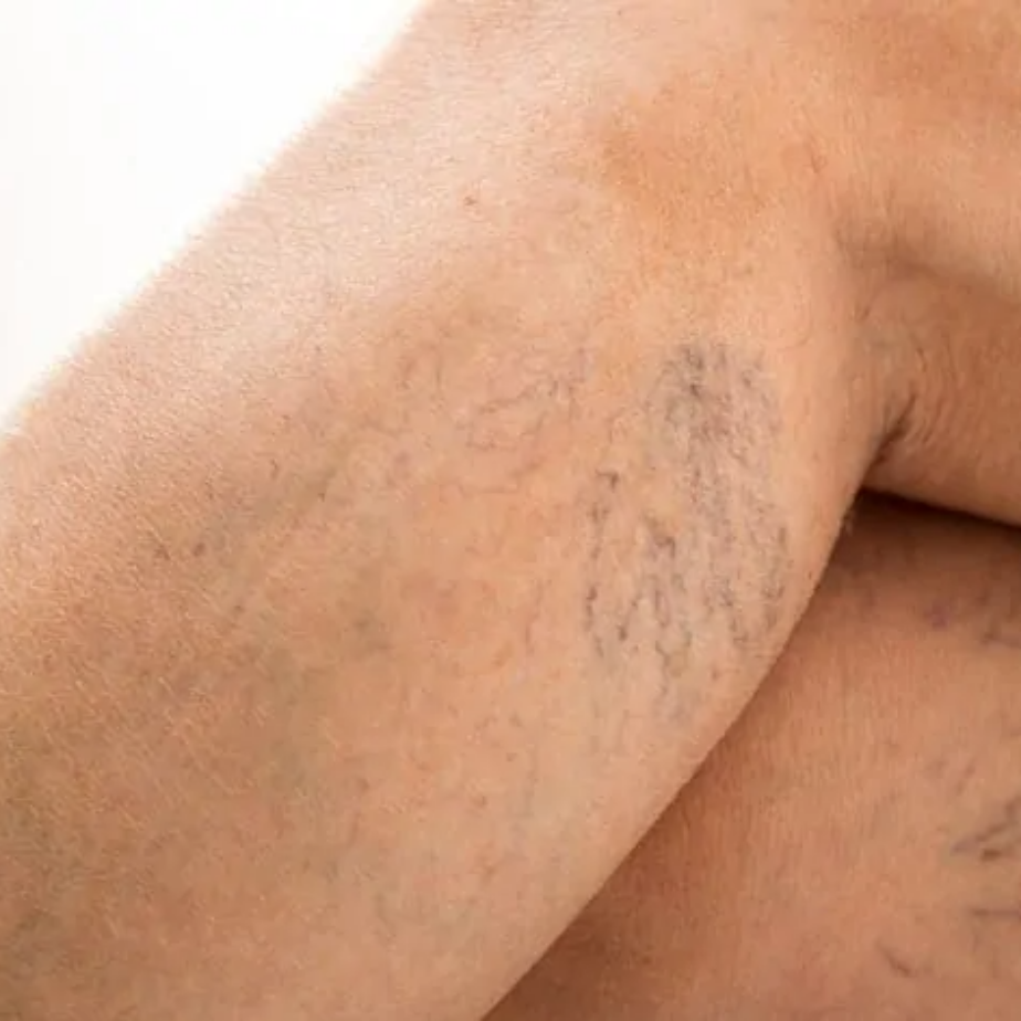 Ontsierende bloedvaatjes op de benen: soms een voorbode van spataders