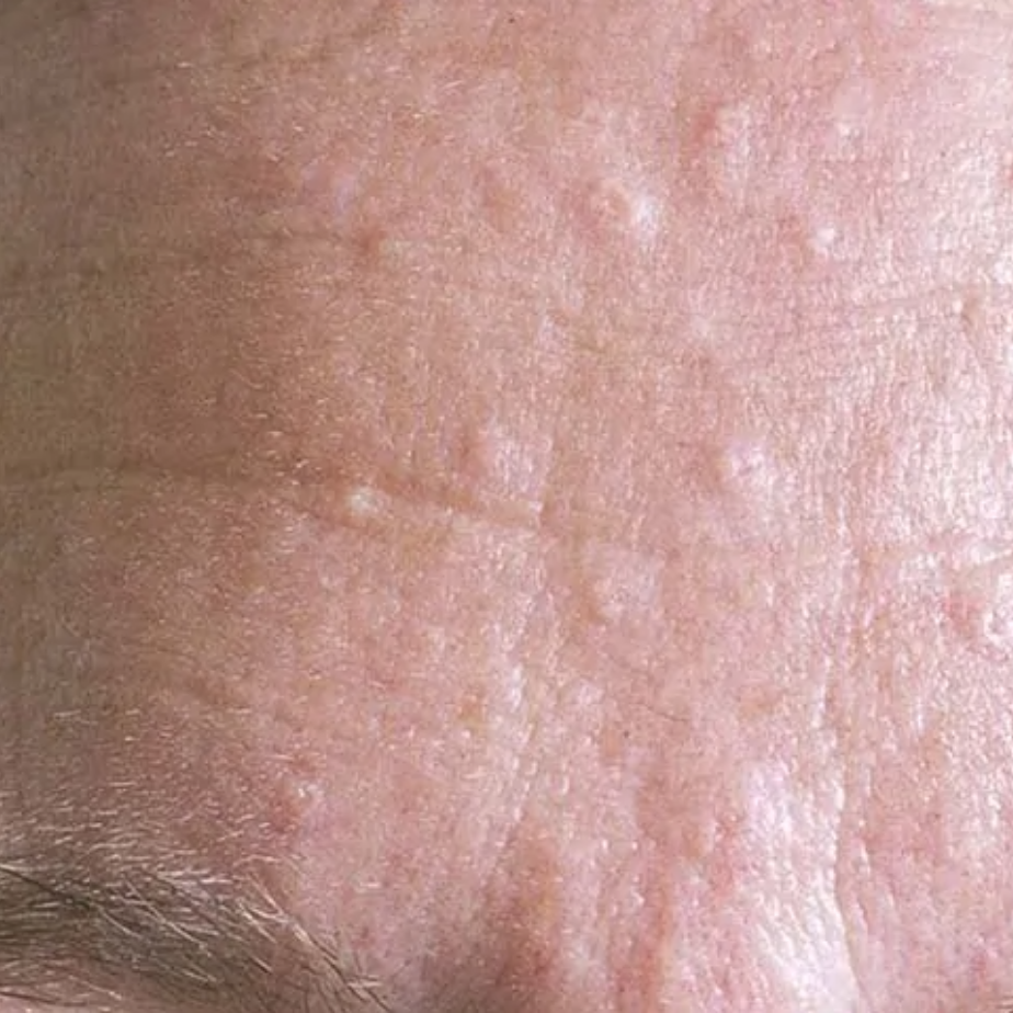 Huidprobleem Talgklierhyperplasie West